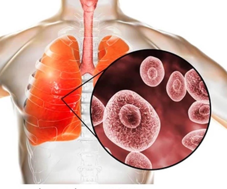 Yếu tố nguy cơ nhiễm nấm phổi do Aspergillus-1