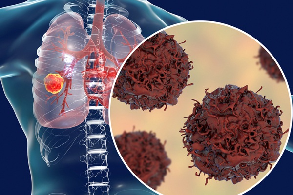 Triệu chứng của ung thư phổi giai đoạn sớm-1