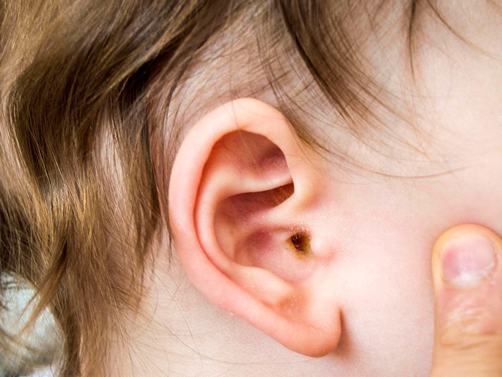 Phát hiện sớm viêm tai giữa mạn tính ở trẻ nhỏ, tránh bị điếc-2