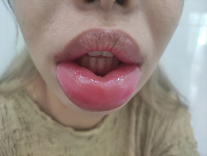 Từ vụ cô gái miệng biến dạng sau tiêm filler môi: BS cảnh báo điều quan trọng khi đi làm đẹp-1