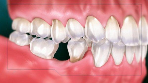 Viêm nướu có thể gây mất răng-2