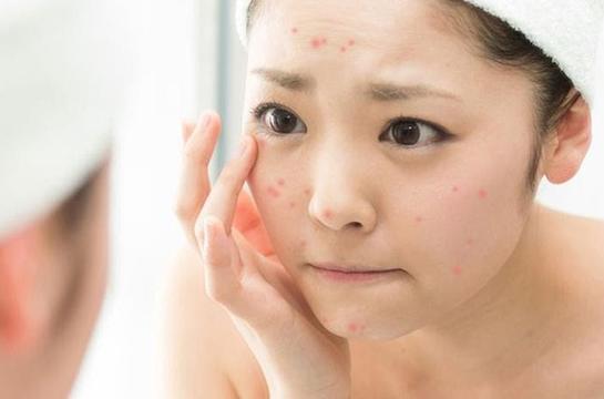5 dấu hiệu cảnh báo da bị thiếu ẩm nghiêm trọng mà phụ nữ nào cũng nên biết và cách cải thiện-2