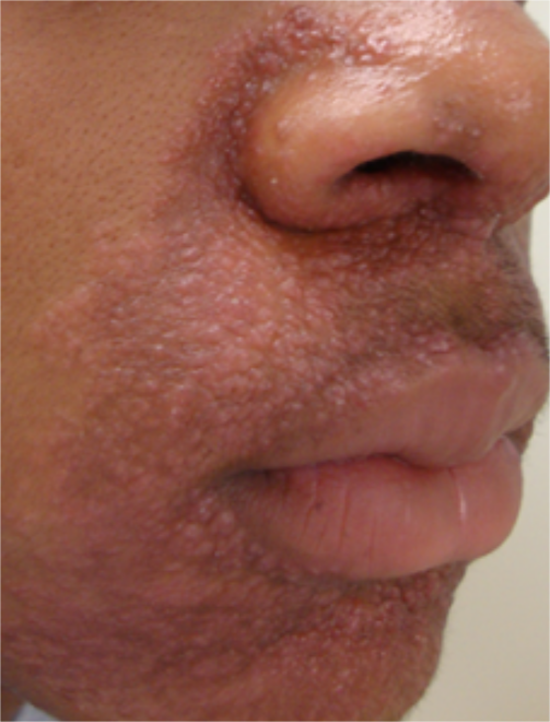 Viêm da quanh miệng: Các dạng tổn thương và cách chữa trị-2