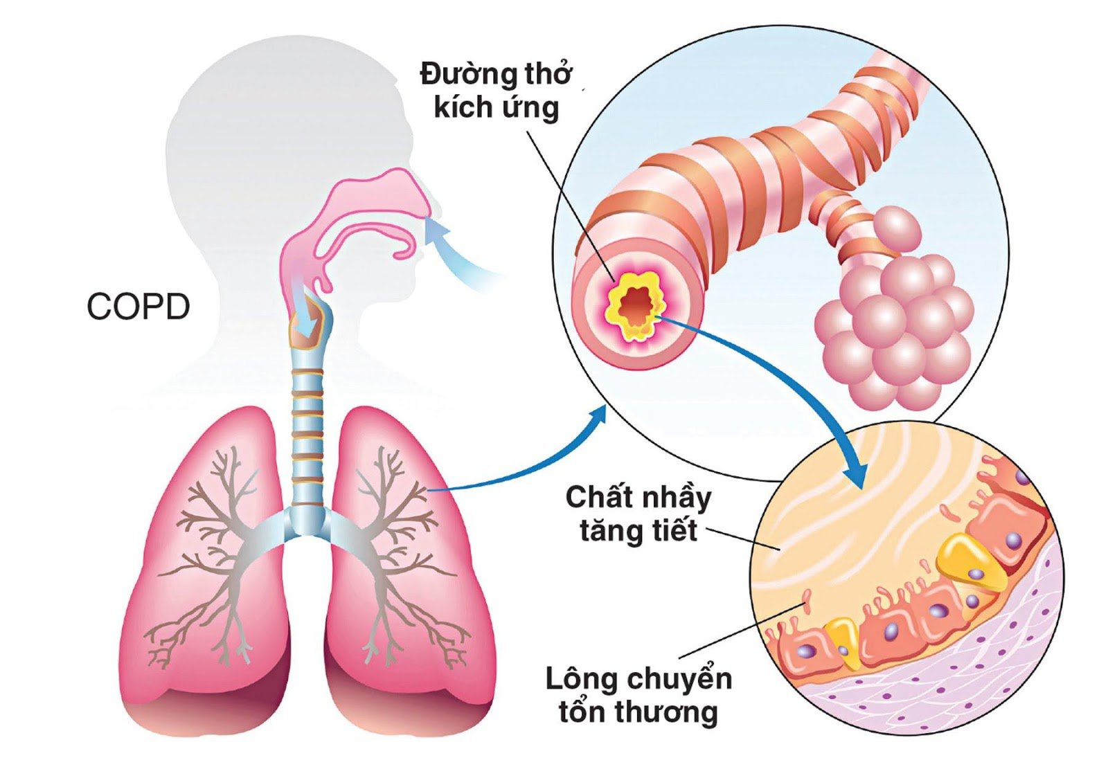 Phòng ngừa và hạn chế đợt cấp của bệnh phổi tắc nghẽn mạn tính trong mùa hè-3