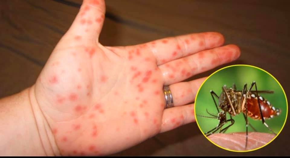 Đã có hơn 124.000 ca mắc, 40 người tử vong do sốt xuất huyết; dấu hiệu nguy hiểm của bệnh-1