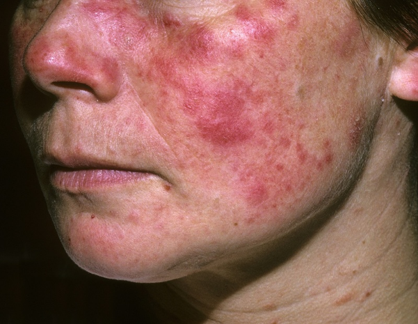 Lupus ban đỏ ảnh hưởng đến tuổi thọ như thế nào?-1