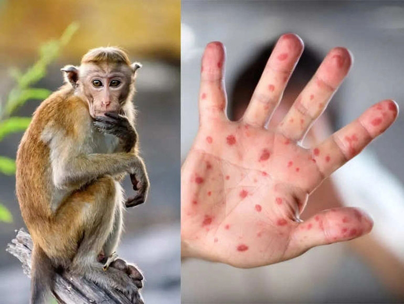 Hướng dẫn chẩn đoán, điều trị, phân biệt bệnh đậu mùa khỉ với các bệnh khác-1