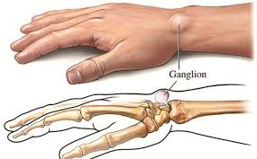 Những yếu tố nguy cơ nào dẫn đến nang bao hoạt dịch cổ tay?-1