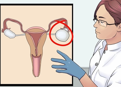 Đa nang buồng trứng và nguy biến khó lường-2