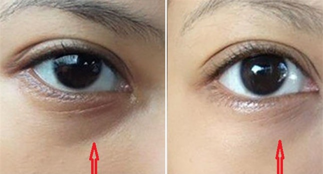 Mẹo trị thâm mắt đơn giản mà hiệu quả không kém đi spa-1