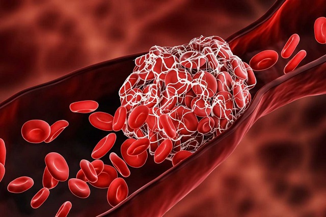 Độ nhớt của máu có thể liên quan tới nguy cơ tử vong do COVID-19-2