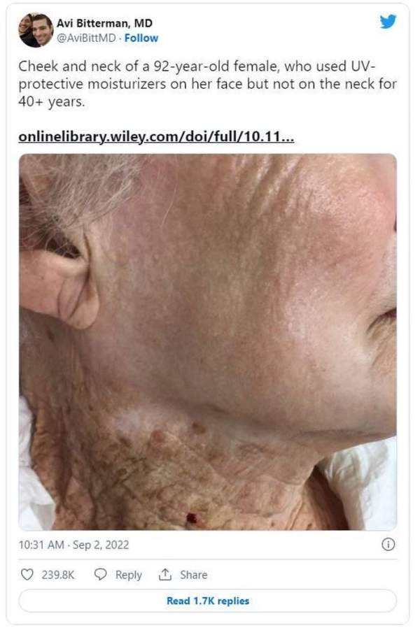 Bức ảnh về người phụ nữ 92 tuổi này là lời nhắc nhở nghiêm khắc cho việc dùng kem chống nắng-2