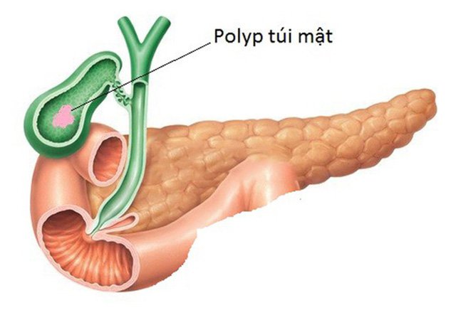 Cảnh giác polyp túi mật có nguy cơ chuyển thành ung thư-1
