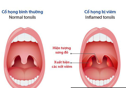 Viêm họng mạn tính có lây sang viêm xoang?-2