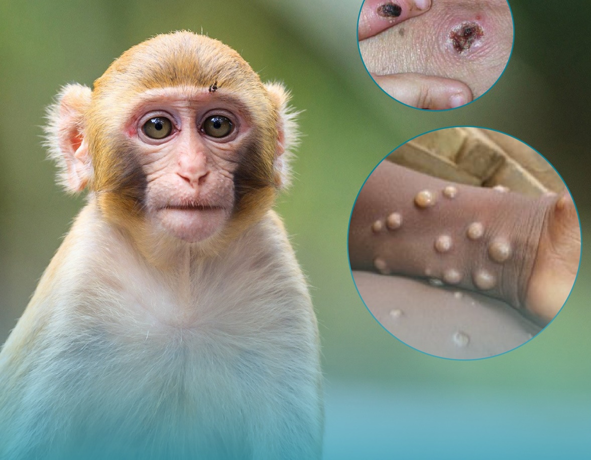 Nóng: Bộ Y tế ban hành hướng dẫn chẩn đoán, điều trị và phòng bệnh đậu mùa khỉ ở người-2
