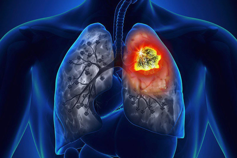 Chân xuất hiện 3 điểm bất thường này coi chừng ung thư phổi-1
