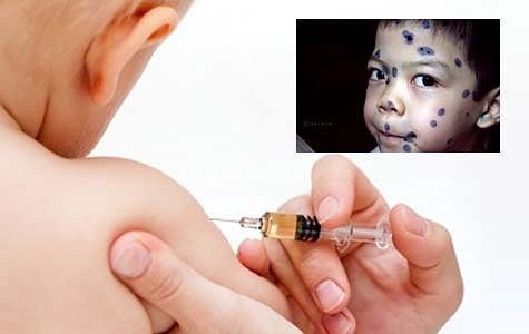 Tiêm vaccine giúp phòng ngừa bệnh thủy đậu hiệu quả, đơn giản-1