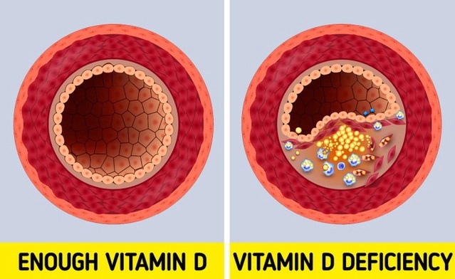6 dấu hiệu cảnh báo cơ thể thiếu vitamin D, cần làm ngay 5 việc để bổ sung-3