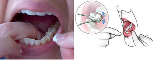 Viêm nướu có thể gây mất răng-3