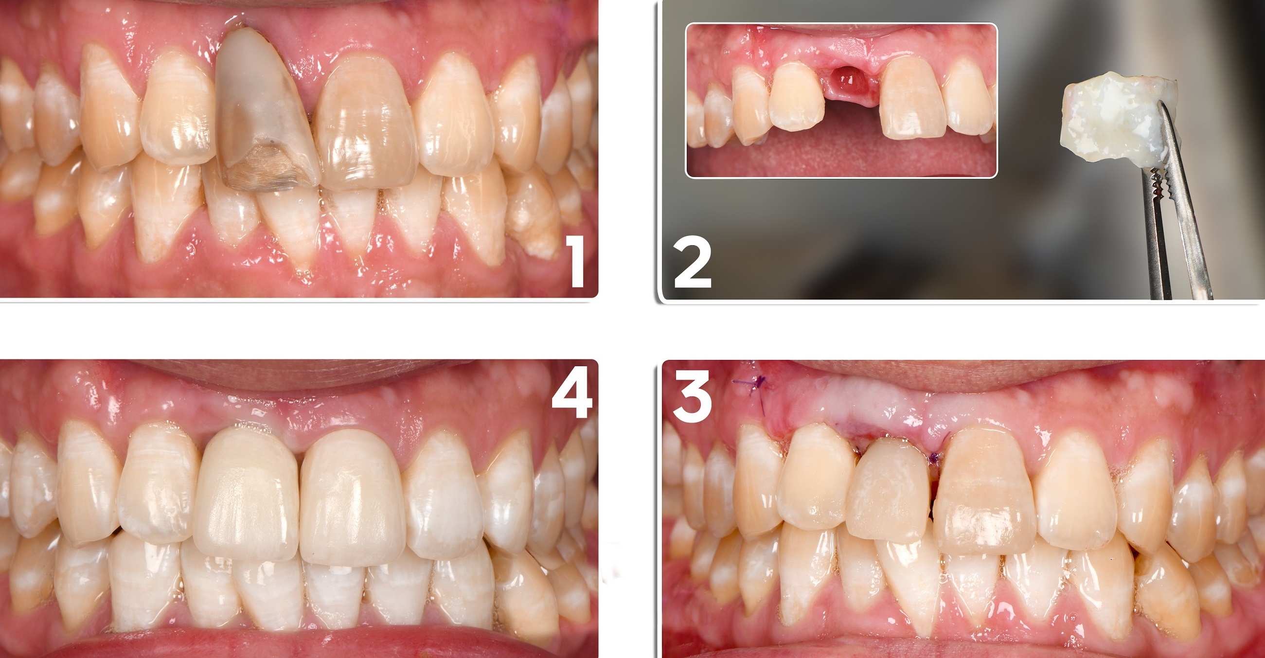 Giải pháp phục hồi mất răng và tiêu xương ở người trẻ-3