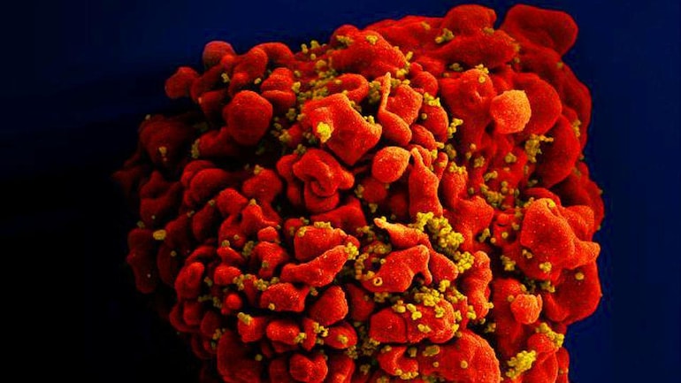 Thoát khỏi 'án tử', HIV được chữa khỏi ở bệnh nhân lớn tuổi nhất sau khi cấy ghép tế bào gốc-1