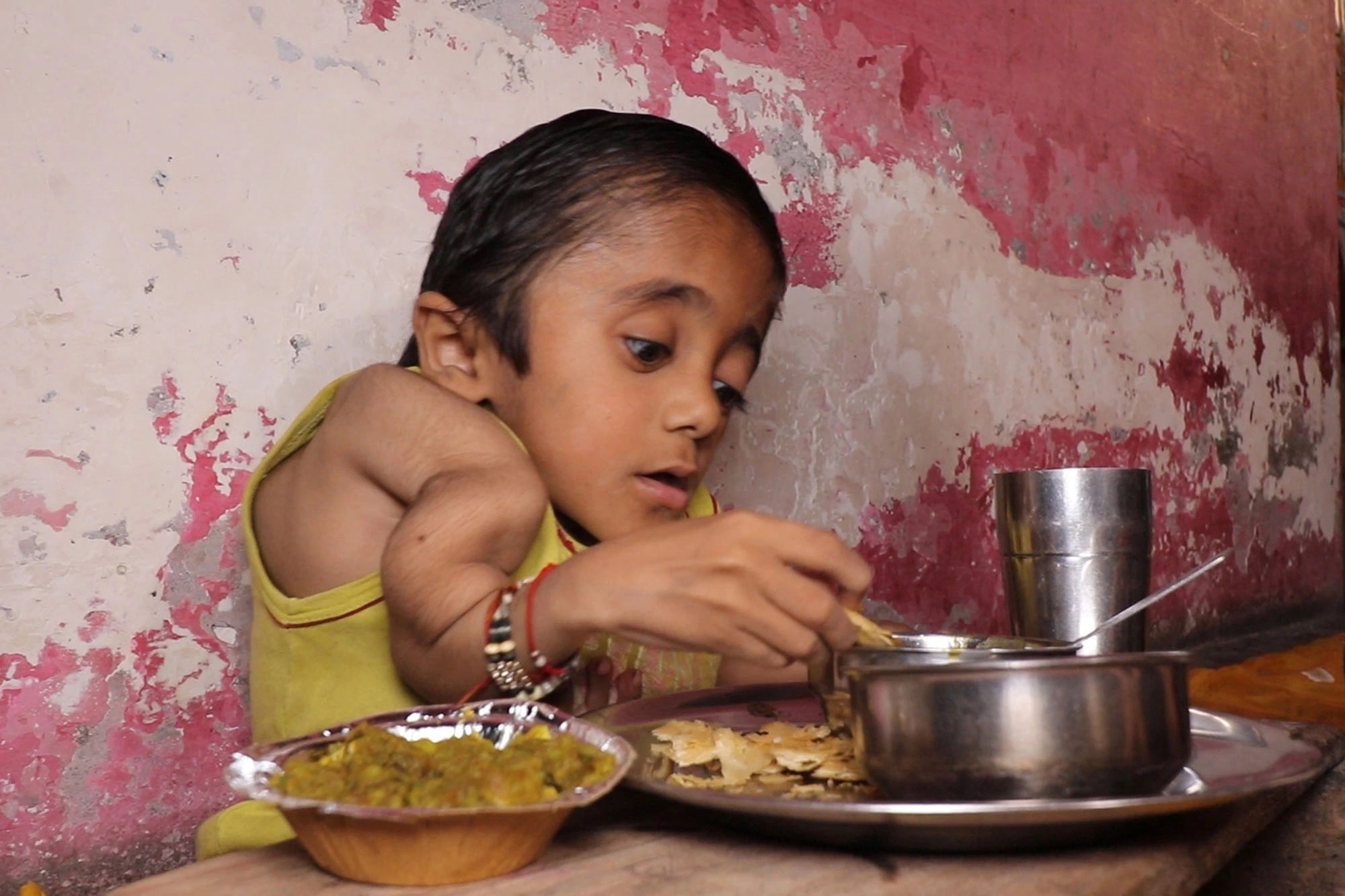 Em bé ở Ấn Độ bị gãy 100 chiếc xương vì bệnh hiếm-2