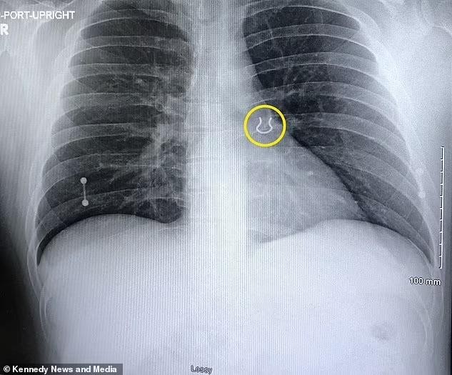 Người đàn ông nhập viện vì ho dữ dội, ảnh chụp X-quang tiết lộ điều khó tin-1