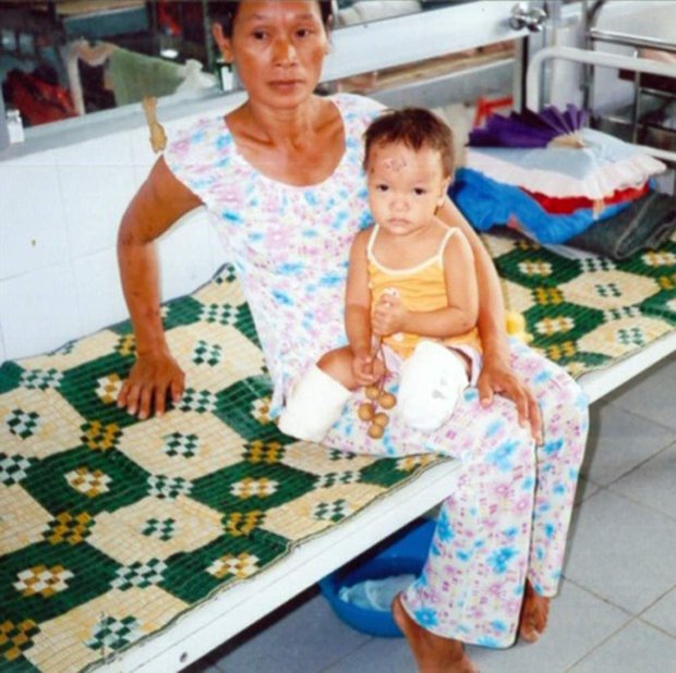 Cuộc sống hiện tại của bé gái gốc Việt bị bố mẹ nổ bom mất 2 chân: Được báo chí thế giới gọi là 'nữ kình ngư thần kỳ', trở thành đại sứ truyền cảm hứng cho những người khuyết tật-5