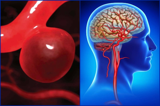 Phình mạch máu: Dấu hiệu nhận biết và những nguy cơ cho sức khoẻ-1