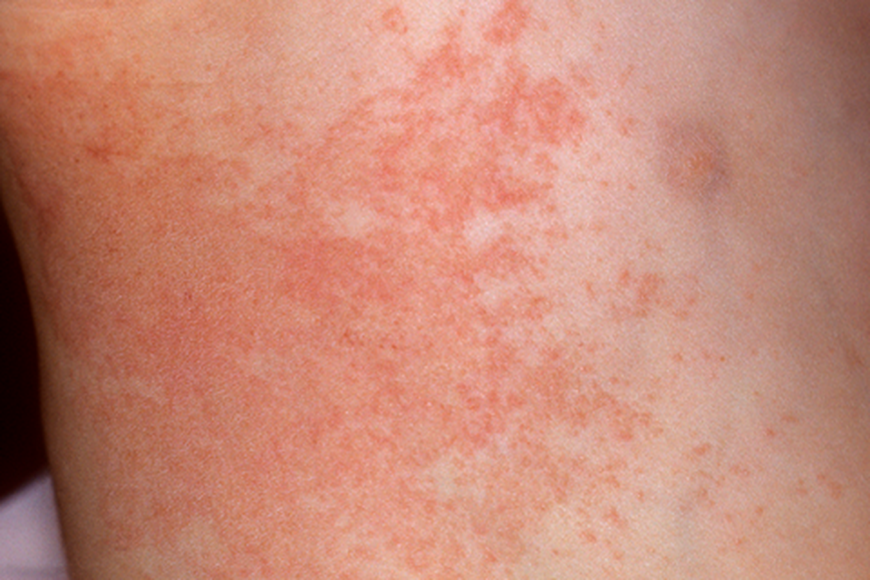 6 vấn đề của làn da khi nắng nóng và mẹo để phục hồi-1