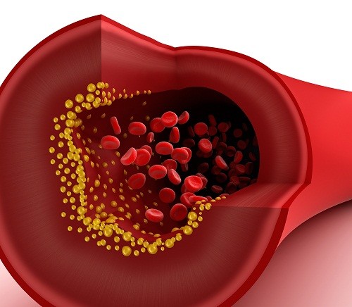 Rối loạn lipid máu - căn bệnh nguy hiểm hàng triệu người mắc phải-2