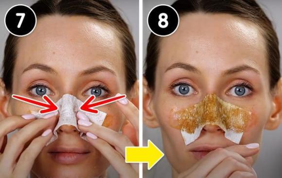 4 cách để loại bỏ mụn đầu đen trên mũi của bạn-11