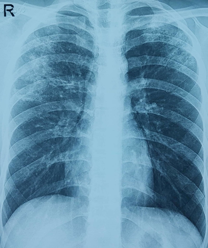 Bác sĩ cảnh báo tình trạng mắc lao phổi hậu Covid-19-1