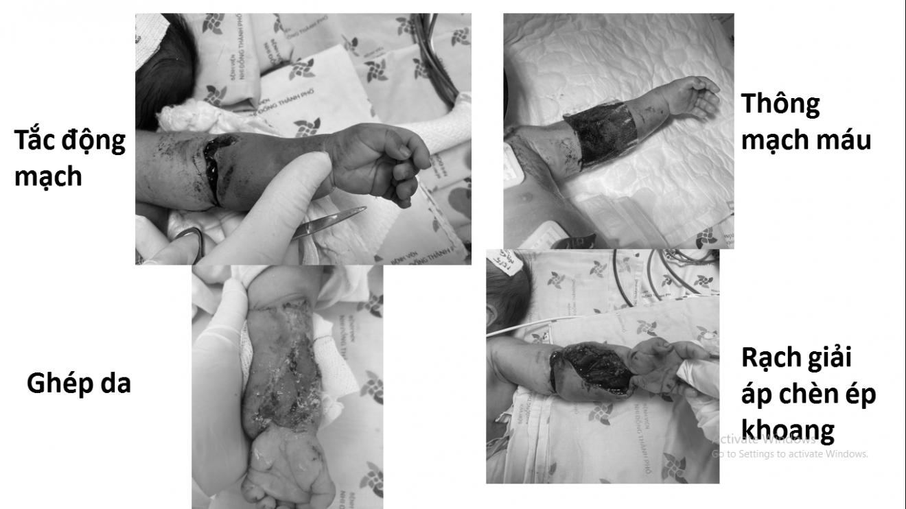 Bé 1,5 tháng tuổi suýt bị đoạn chi vì bị máy may đè nát tay-1