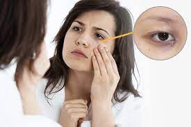 Mắt thâm quầng không chỉ do thức khuya mà cơ thể đang âm thầm "chống chịu" 5 vấn đề sức khỏe sau-1
