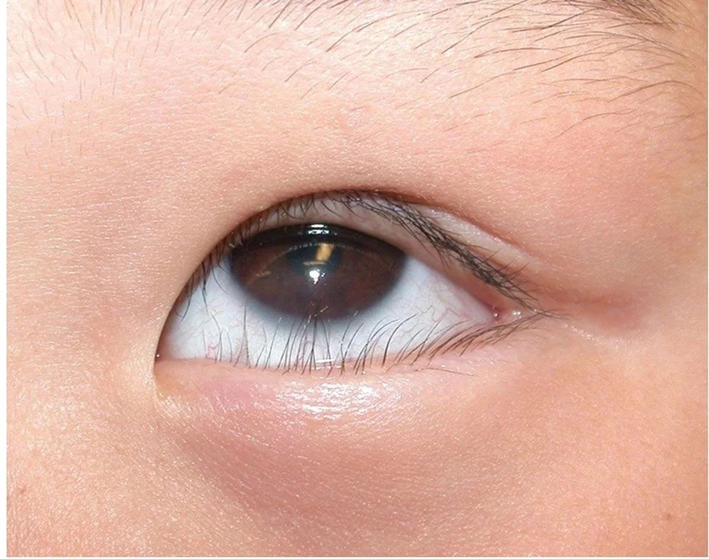 Chuyên gia nhãn khoa Hitec lý giải nguyên nhân trẻ bị đau mắt đỏ tái phát liên tục-1