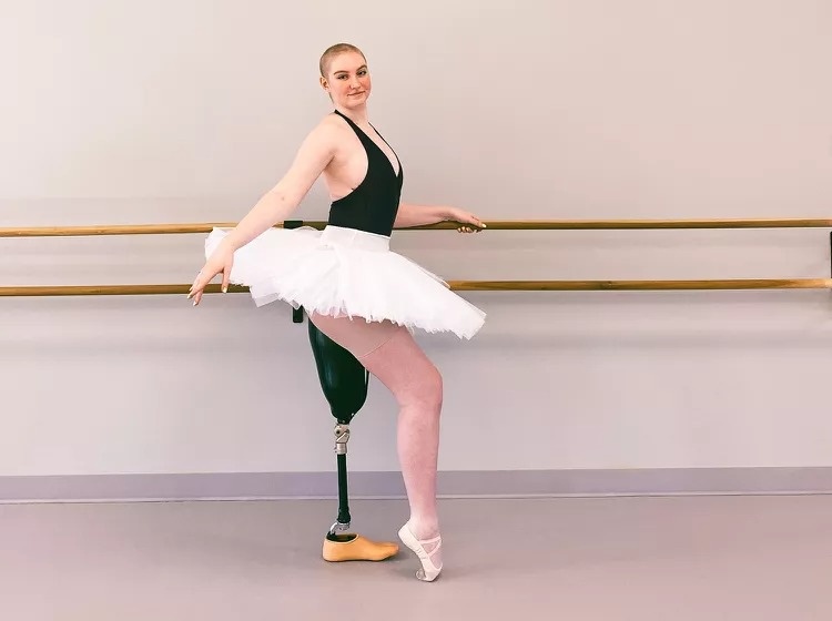 Nữ vũ công 21 tuổi sau khi bị cắt một chân-2