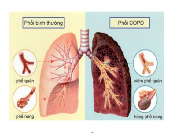 Phòng ngừa và hạn chế đợt cấp của bệnh phổi tắc nghẽn mạn tính trong mùa hè-1