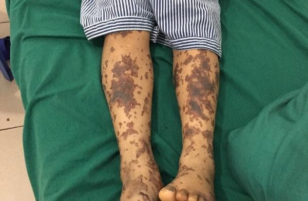 Không ăn tiết canh, một người đàn ông tại Hà Nội vẫn nhiễm liên cầu khuẩn lợn-1