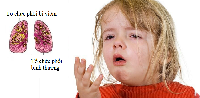 Vì sao cần tái khám khi điều trị viêm phổi ở trẻ em?-2