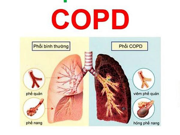 Lactoferrin dưỡng chất vàng cho bệnh nhân COPD, hen suyễn không thể bỏ qua!-1