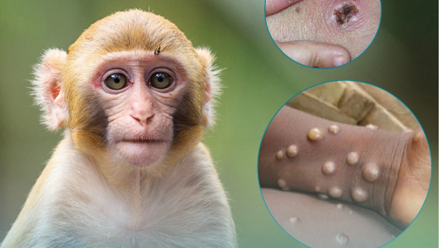Hướng dẫn cách phân biệt đậu mùa khỉ với thủy đậu, tay chân miệng và Herpes lan tỏa-1