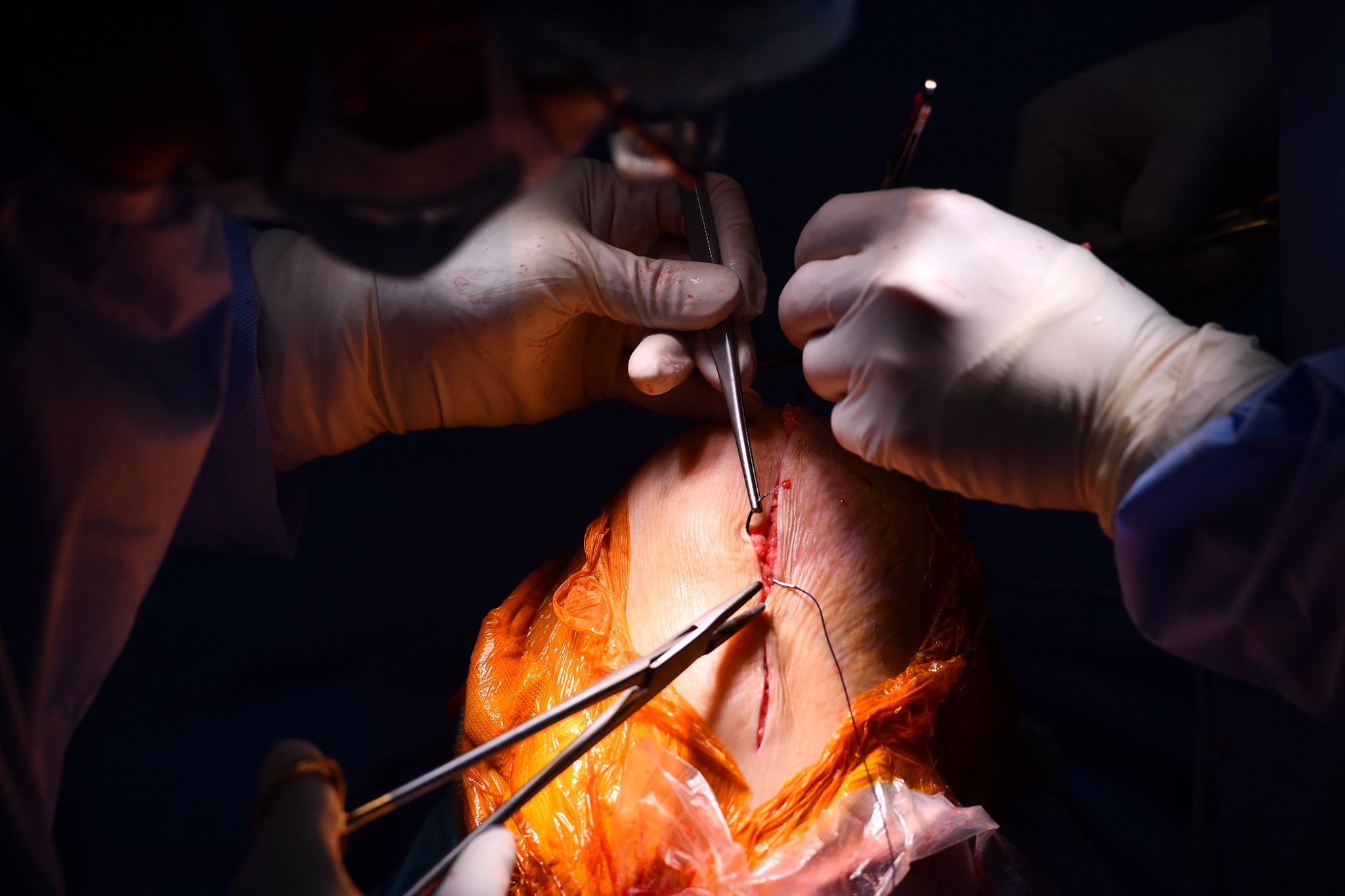 Ứng dụng công nghệ thực tế ảo trong phẫu thuật thay khớp gối-19