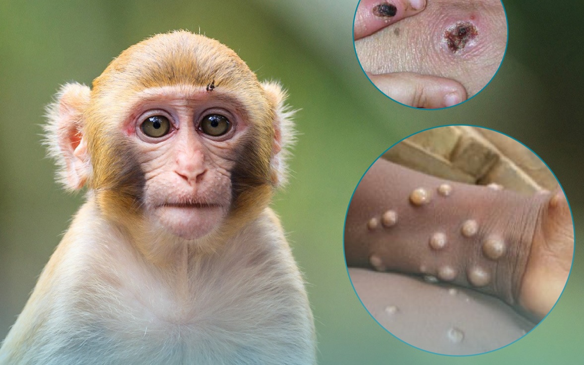 Thế giới có 44.503 ca đậu mùa khỉ, Bộ Y tế hướng dẫn cách phòng ngừa lây nhiễm tại cơ sở y tế-1