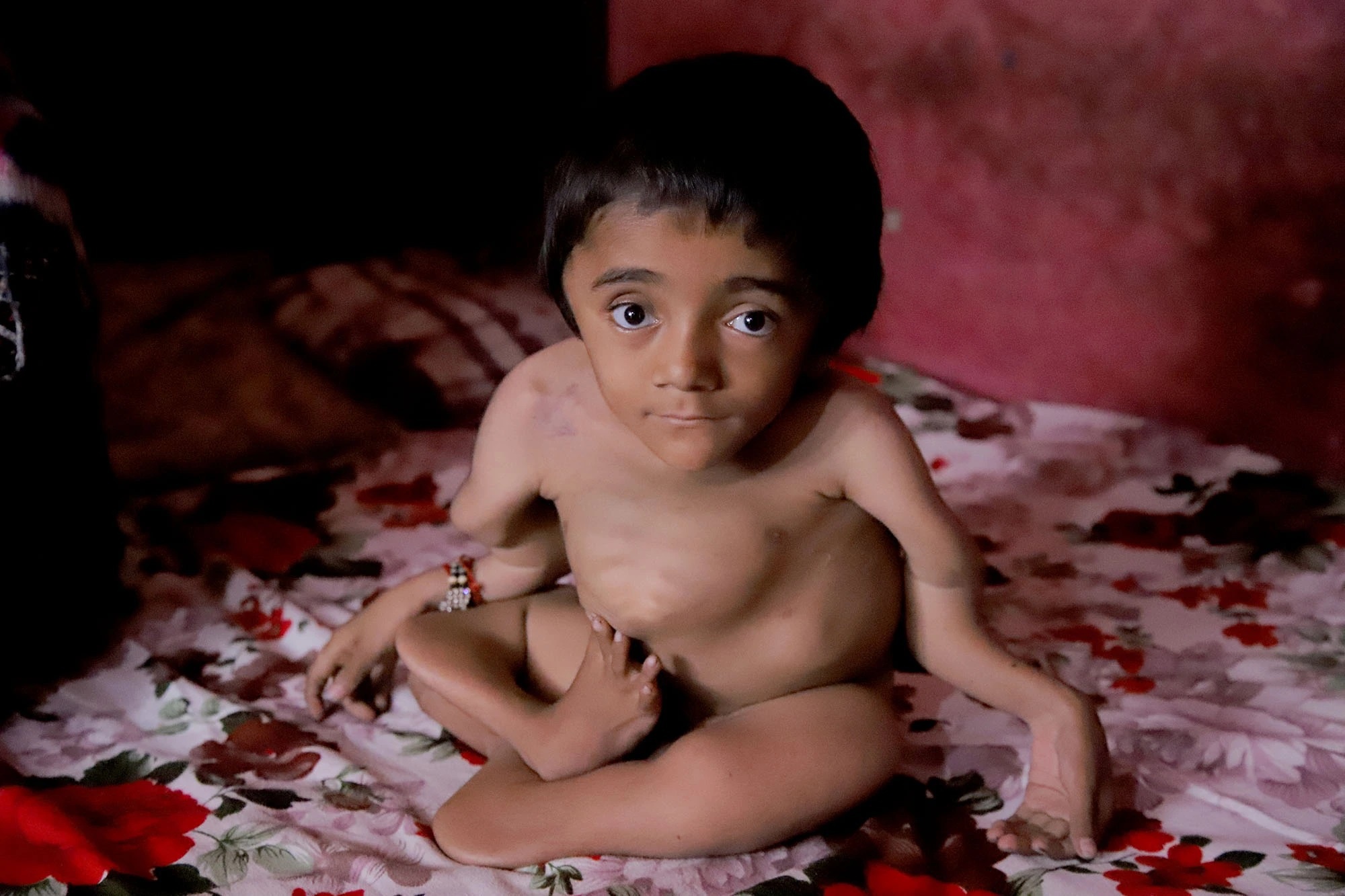Em bé ở Ấn Độ bị gãy 100 chiếc xương vì bệnh hiếm-1