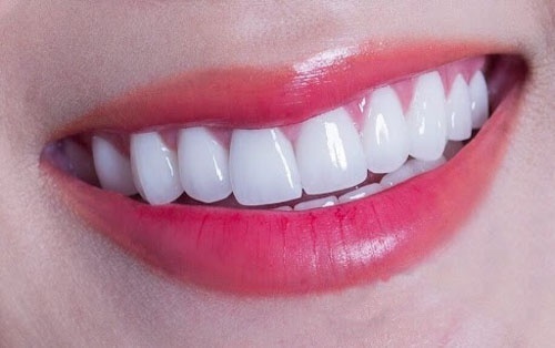 Không phải răng trắng tinh là tốt cho sức khỏe-3