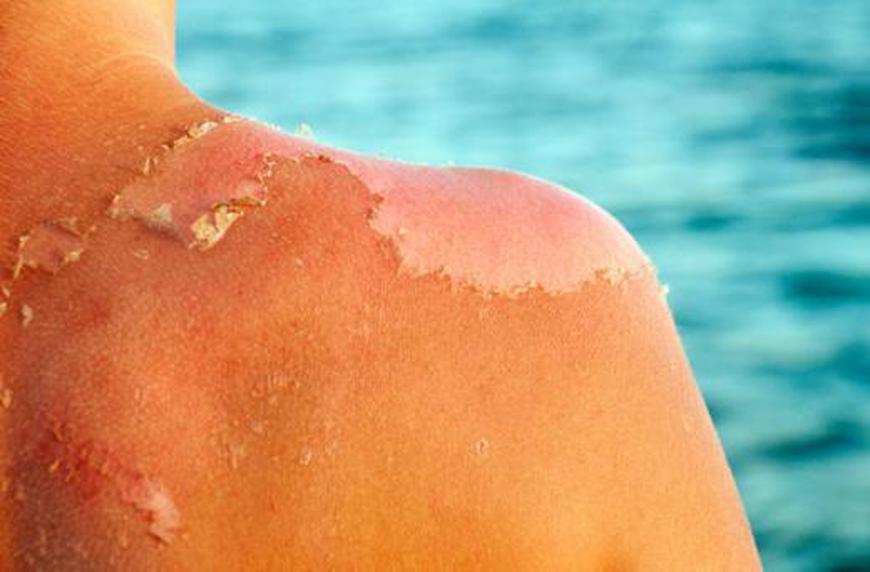 6 vấn đề của làn da khi nắng nóng và mẹo để phục hồi-2