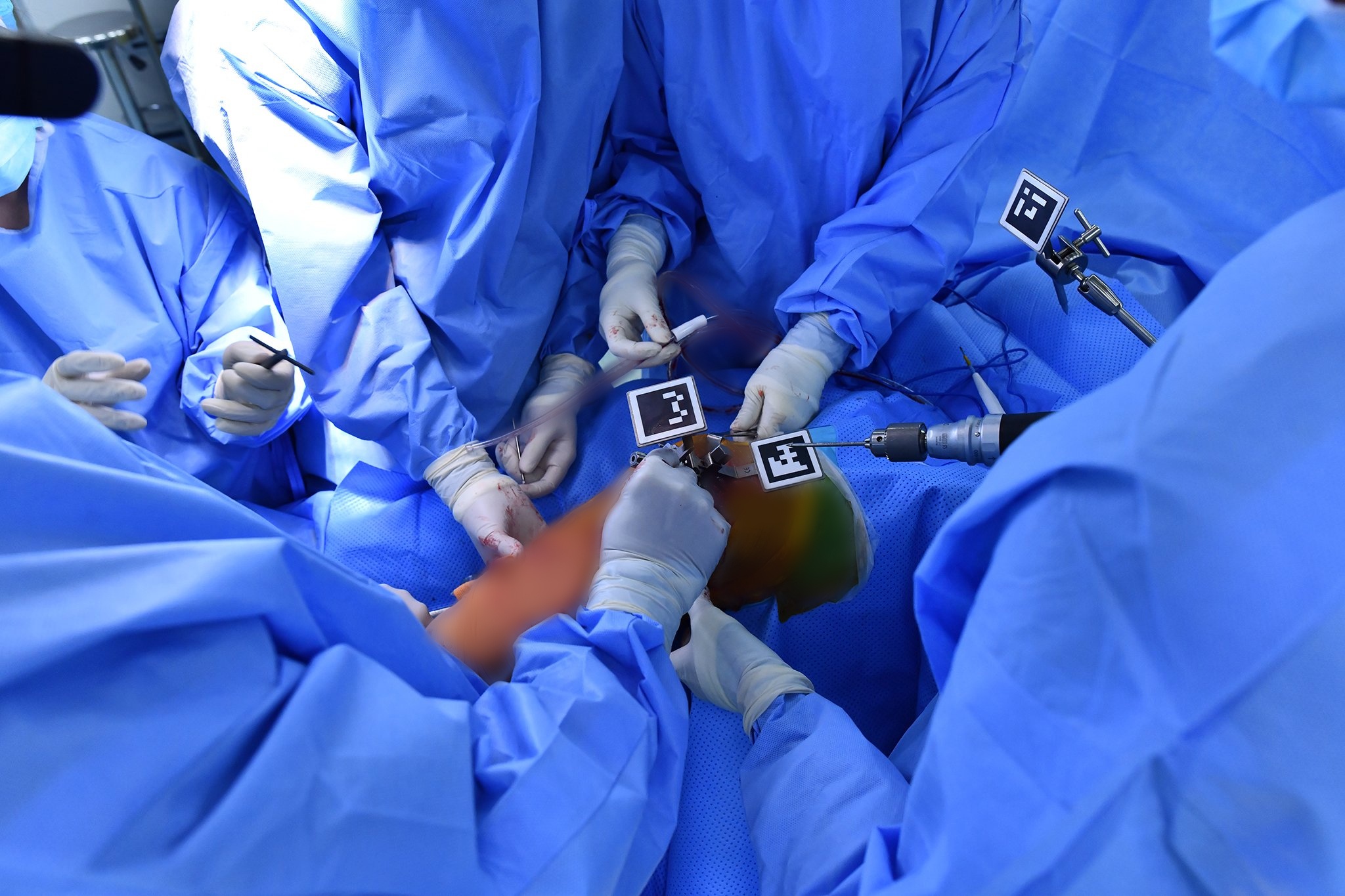 Ứng dụng công nghệ thực tế ảo trong phẫu thuật thay khớp gối-16