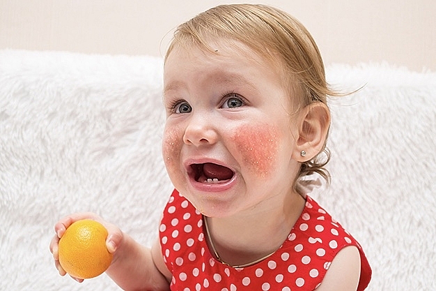 Những thực phẩm có thể gây dị ứng cho trẻ nhỏ và cách xử lý-1