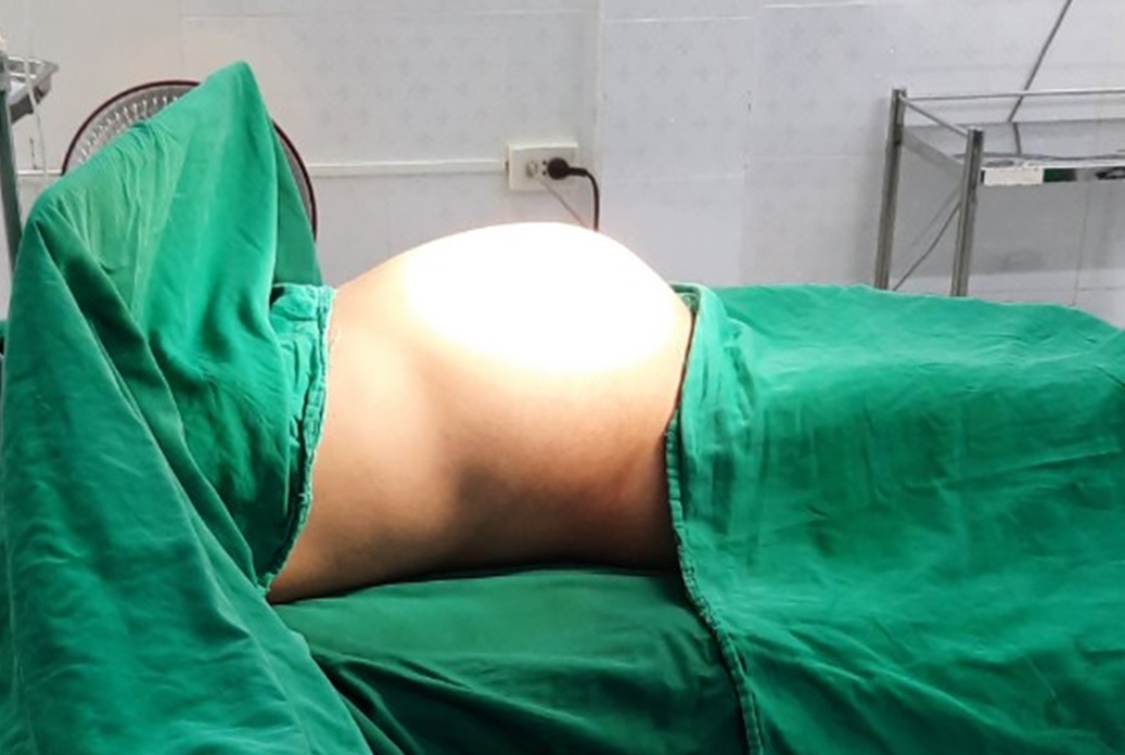 Cắt khối u buồng trứng khổng lồ nặng 10kg giải thoát cho cô gái trẻ-1